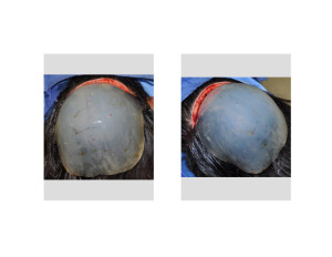Custom Occipital Implant Dr Barry Eppley Indianapolis