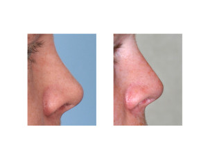 Dorsal Rib Graft Rhinoplasty Dr Barry Eppley Indianapolis