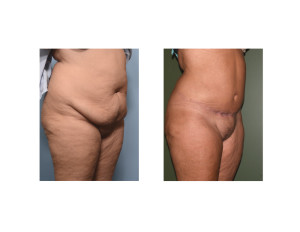 Extended Tummy Tuck results oblique view Dr Barry Eppley Indianapolis
