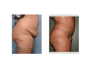 Extended Tummy Tuck results side view Dr Barry Eppley Indianapolis