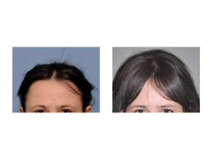 Extreme Occipital Augmentation result front view Dr Barry Eppley Indianapolis