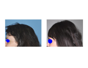 Extreme Occipital Augmentation result side view