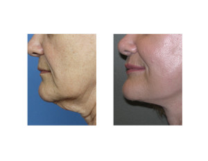 Facelift Surgery Dr Barry Eppley Indianapolis