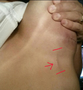 Mondor's Cord after Breast Augmentation Dr Barry Eppley Indianapolis