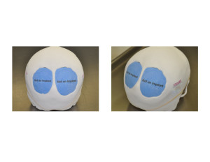 PEKK Cranial Implant Designs Dr Barry Eppley Indianapolis