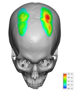 Parasagittal Skull Implant Thicknesses Dr Barry Eppley Indianapolis