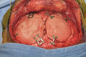 Pekk Cranial Implant Reconstruction Dr Barry Eppley Indianapolis
