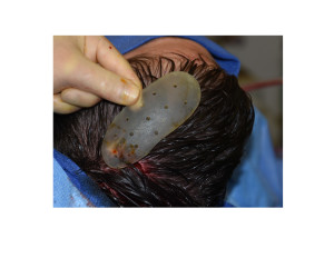 Perforated Skull Implants Dr Barry Eppley Indianapolis