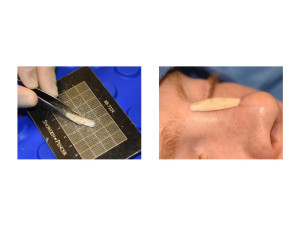 Rib Graft Shaping for Rhinoplasty Dr Barry Eppley Indianapolis