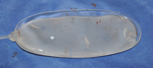 Scalp Tissue Expander Dr Barry Eppley Indianapolis