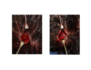 Screw Fixation of Parasagittal Skull Implants Dr Barry Eppley Indianapolis