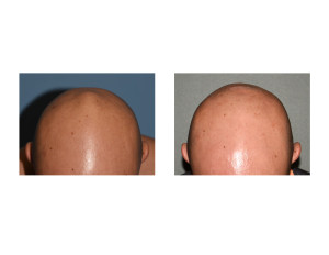 Skull Bump Reduction result top view Dr Barry Eppley Indianapolis