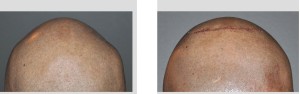 Skull Implant fo Sagittal Ridge Deformity result back view Dr Barry Eppley Indianapolis