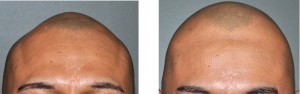 Skull Implant for Sagiittal Ridge Deformity Dr Barry Eppley Indianapolis