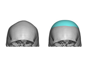 Skull Implant for Sagittal Ridge Deformity design Dr Barry Eppley Indianapolis