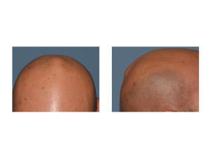 Vertex Skull Bump Preop Dr Barry Eppley Indianapolis