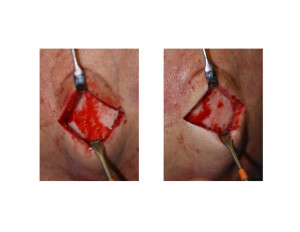 Vertex Skull Bump reduced intraop Dr Barry Eppley Indianapolis