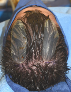 parasagittal skull implants