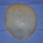 perforated skull cap implant dr barry eppley indianapolis
