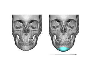 Custom Chin Implant design front view Dr Barry Eppley Indianapolis