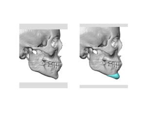 Custom Chin Implant design side view Dr Barry Eppley Indianapolis
