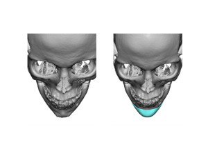 Custom Chin Implant design top view Dr Barry Eppley Indianapolis