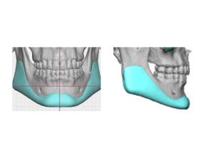 Custom Jawline Implant design Dr Barry Eppley Indianapolis