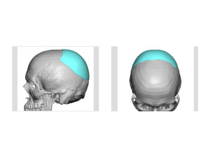 Custom Occipital Implant design Indianapolis Dr Barry Eppley