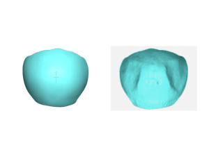 Custom Skull Implant for Occipital Dents design Dr Barry Eppley Indianapolis