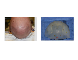 Custom Skull Implant for Occipital Dents intraoperative placement Dr Barry Eppley Indianapolis