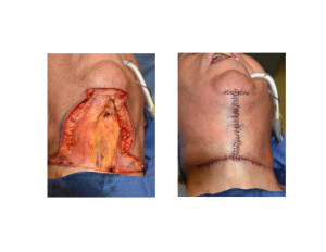 Direct Necklift Excision and Closure intraop Dr Barry Eppley Indianapolis