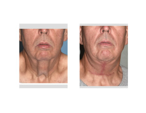 Direct Necklift after Massive Weight Loss result front view Dr Barry Eppley Indianapolis