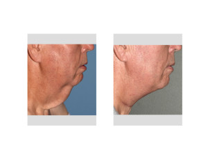 Direct Necklift after Massive Weight Loss result side view Dr Barry Eppley Indianapolis