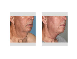 Direct Necklift result obloque view Dr Barry Eppley Indianapolis