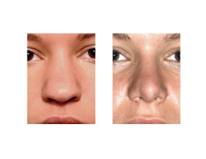 Ethnic Rhinoplasty result front view