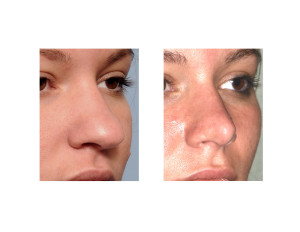 Ethnic Rhinoplasty result oblique view