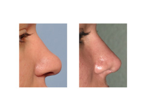 Ethnic Rhinoplasty result side view