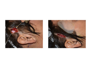 Extended Anterior Temporal Implant placement surgical technique 1 Dr Barry Eppley Indianapolis
