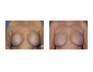 Fat Grafting after Removal of 40 Year Old Breast Implants result front view Dr Barry Eppley Indianapolis