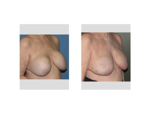 Fat Grafting after Removal of 40 Year Old Breast Implants result oblique view Dr Barry Eppley Indianapolis