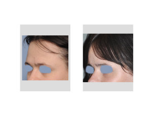 Female Forehead Augmentation result oblique view Dr Barry Eppley Indianapolis