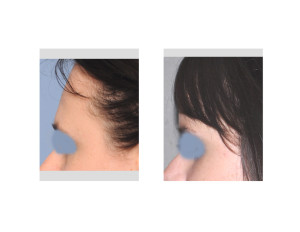 Female Forehead Augmentation result side view Dr Barry Eppley Indianapolis