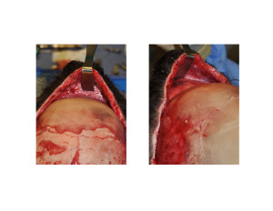 Female Forehead Augmentation with PMMA Bone Cement intraop Dr Barry Eppley Indianapolis
