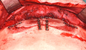 Microplate Fixation Brow Bone Reduction Dr Barry Eppley Indianapolis