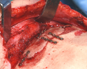 Microplate Fixation Brow Bone Reduction Indianapolis Dr Barry Eppley