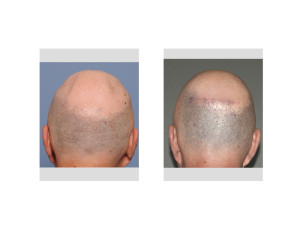 Occipital Dents Custom Skull Implant result Dr Barry Eppley Indianapolis