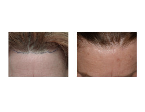 Pretrichial Browlift Scar result long-term Dr Barry Eppley Indianapolis