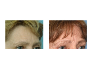 Ten Year Pretrichial Browlift result oblique view Dr Barry Eppley Indianapolis