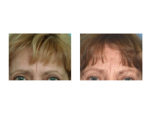 Ten Year Pretriochial Browlift result front view Dr Barry Eppley Indianapolis
