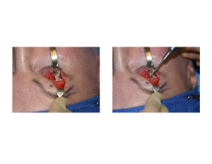 Transpalpebral Brow Bone Reduction Technique Burring Reduction Dr Barry Eppley Indianapolis